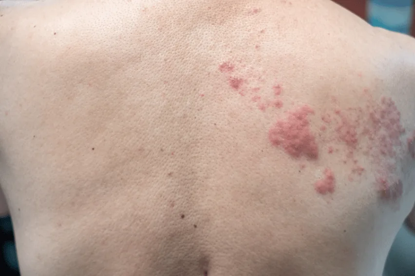 Herpes Zóster: Por que a vacina é indispensável após os 50 anos?